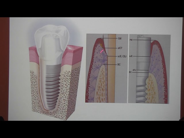 İmplantüstü Protez-101 Dr. Dişhekimi Uğur Ergin - 06 Şubat 2020 class=