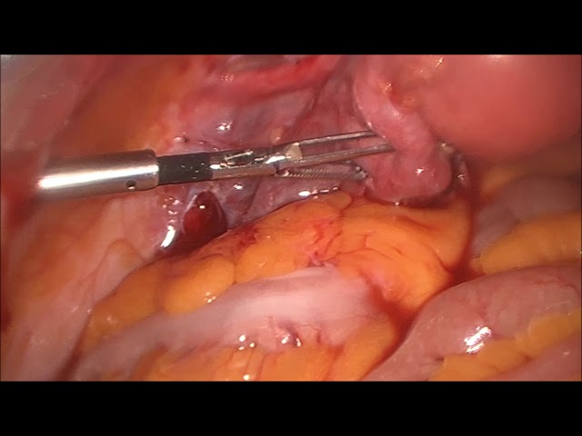 Ooforoplastia direita e liberação de aderências por vídeo/ Oophoroplasty  and video adhesion release 