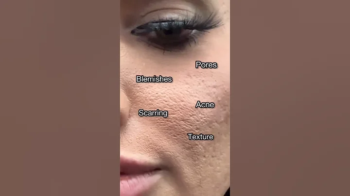 Best Serum for open Pores, Acne & Scarring | The Ordinary Niacinamide 10% Review