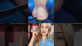 Doctor reacts: ingrown toenail removal