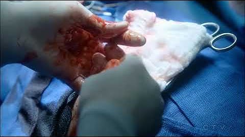 Code Black Ep- 17 Part- 10/12 //Brody critical scene code black// Cameron Boyce critical scene