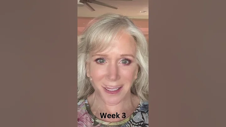 INSANE Day-by-Day Facelift Healing & Recovery Process