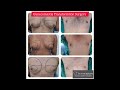 Gynecomastia Surgery in Nepal #gynecomastia #gynecomastianepal #aestheticanepal #drsanjibtripathee
