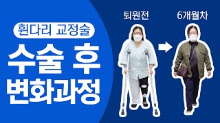 휜다리 수술 후 환자 인터뷰 (휜다리수술_정OO환자)