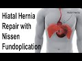 Rparation de hernie hiatale avec la fundoplicature de nissen pour traiter lanimation de reflux