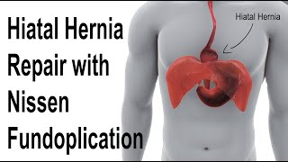 Hiatal Hernia Repair with Nissen Fundoplication to Treat Reflux Animation screenshot 2