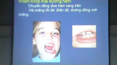 Bai 6  Khám lâm sàng chỉnh nha #1 4