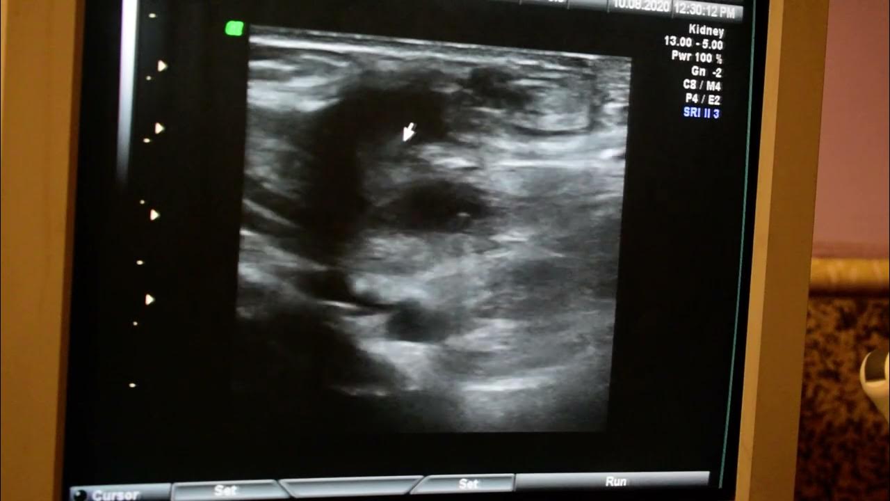 Suture granuloma YouTube