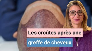 Les croûtes après une greffe de cheveux sont-elles normales ?