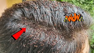 Thousand lice on old lady head - Big lice removal