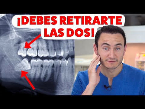 Video: Cómo salvar los dientes perdidos