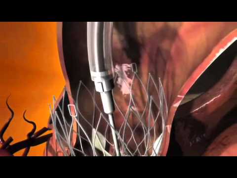 CoreValve - YouTube