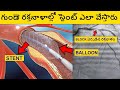 ANGIOGRAPHY మరియు STENT వేయడం అంటే ఎంటి ? | ANGIOGRAPHY and ANGIOPLASTY అంటే ఎంటి అవి ఎలా చేస్తారు?