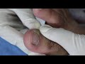 Ep_2492 Infected toenail removal 👣 เจ็บ..ไม่ใช่เล็บ ไม่ใช่หนัง ? 😷 (This clip is from Thailand)