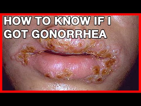 How To Know If I Got Gonorrhea // Treatment And Health Risks