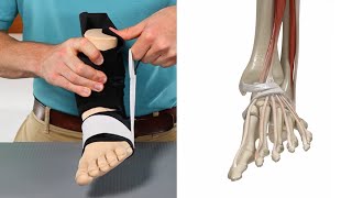 Lateral Ankle Sprains   Treatment and Prevention