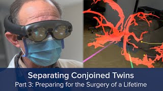 Separating Conjoined Twins Part 3: Preparing for the Surgery of a Lifetime