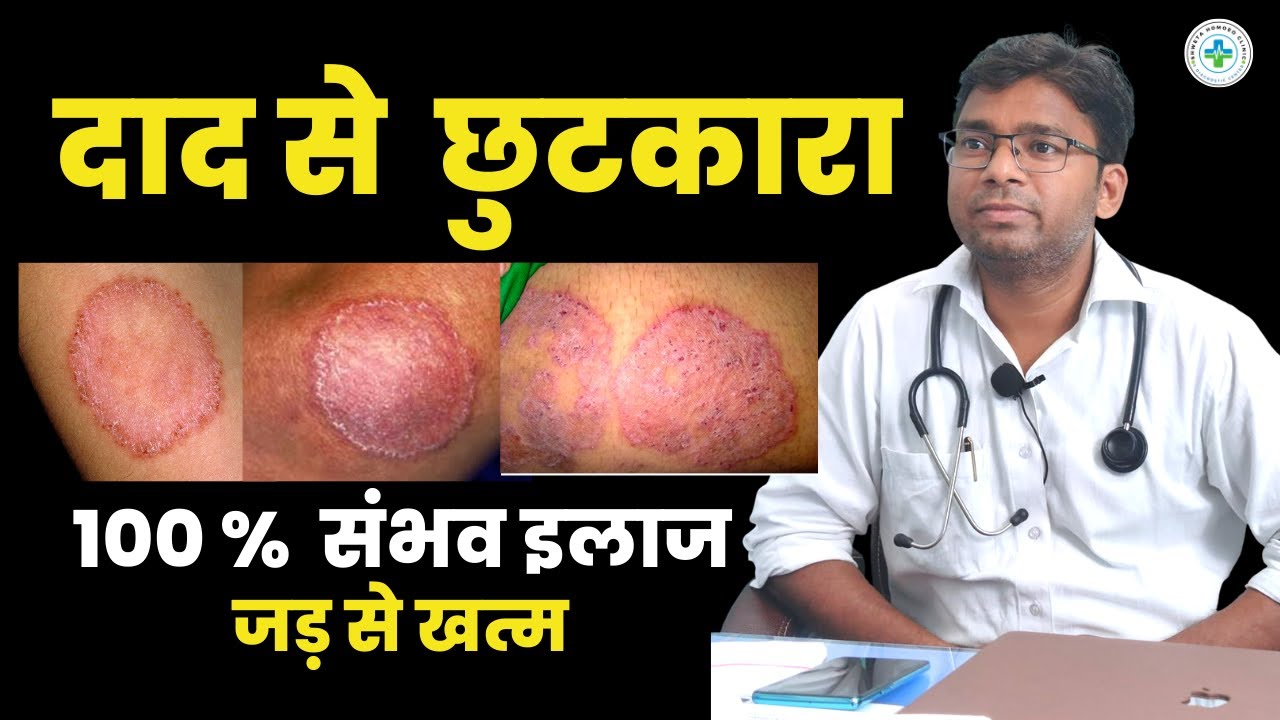 100 Ringworm Cure from Homeopathy Medicine Best Medicine for