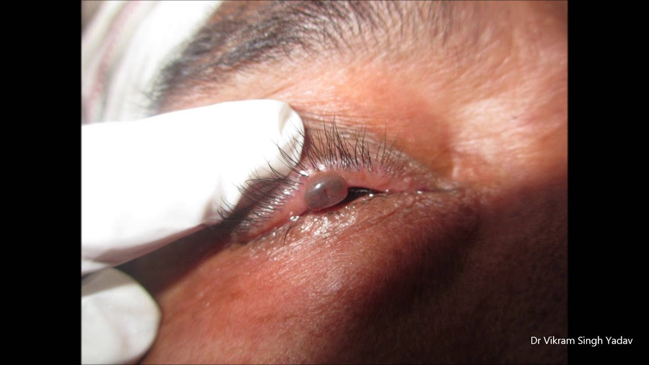 Growth On Eyelids YouTube growth-on-eyelids-youtube