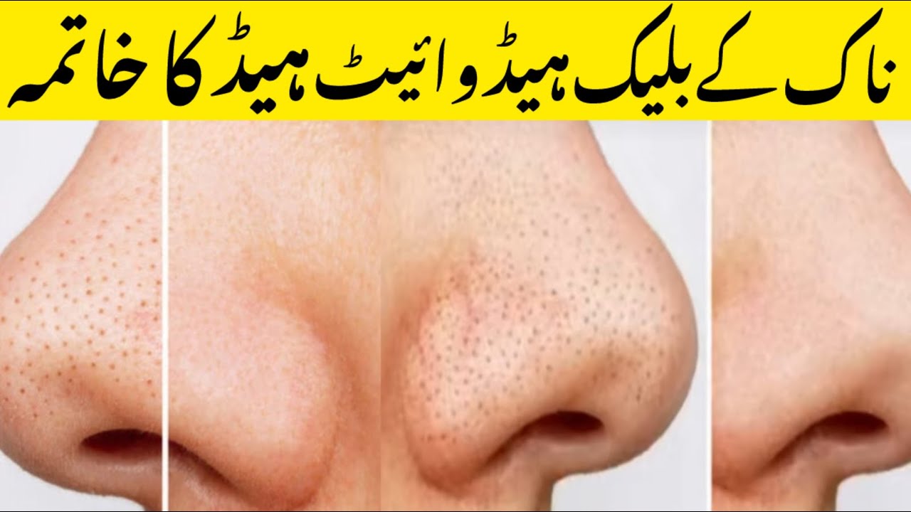 how to remove blackheads | how to remove blackheads from nose | nose