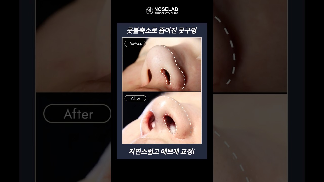 콧볼축소 후 답답해 보이는 이유는? 강차영 원장이 말하는 코재수술 핵심 포인트