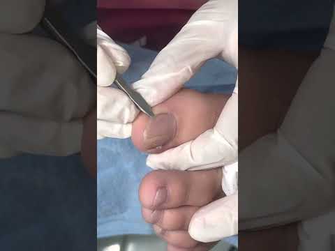 Ep_4427 Ingrown toenail removal 👣 เราต้องทำยังไงหลังจากนี้ครับ 😁 (clip from Thailand)