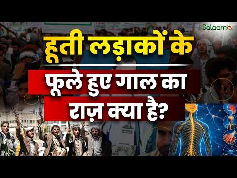 Yemen Crisis : हूती लड़ाकों के फूले हुए गाल का राज़ क्या है? | Houthi | WHO