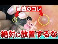 【5分でわかる】頭皮ニキビと吹き出物が出来る原因と正しい対策を発毛のプロが解説