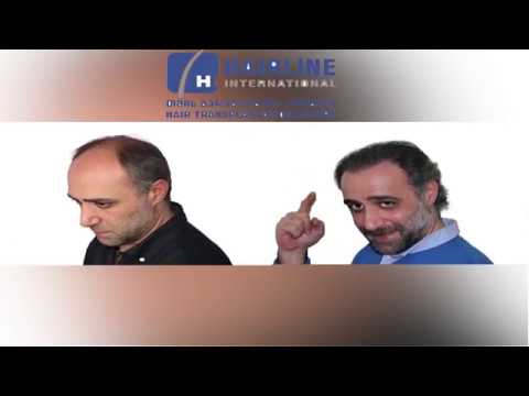 ლევან ყოჩიაშვილი - თმის გადანერგვა ჰეალაინ ინტერნეიშენალში