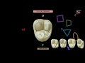 tercer molar superior anatomía