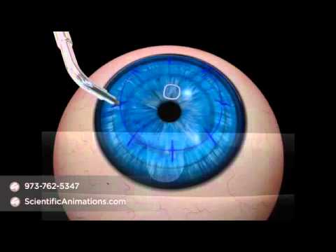 Conductive Keratoplasty Procedure - Ophthalmology Animation