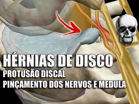 Vídeo: Desordem Da Coluna Vertebral Em Coelhos