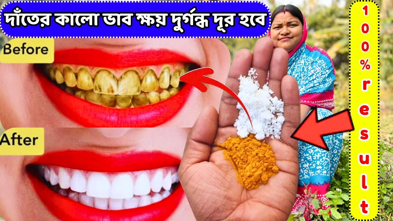মিনিটেই দাঁতের কালো ভাব ক্ষয়  দুর্গন্ধ দূর হবে / tooth cavity problem