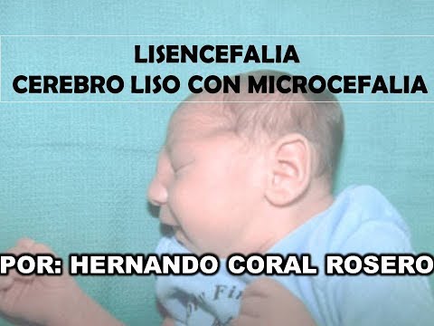 Vídeo: Lisencefalia: Definición, Síntomas Y Más