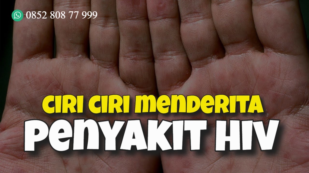Cara Mengobati Hiv Aids Dengan Pengobatan Herbal 