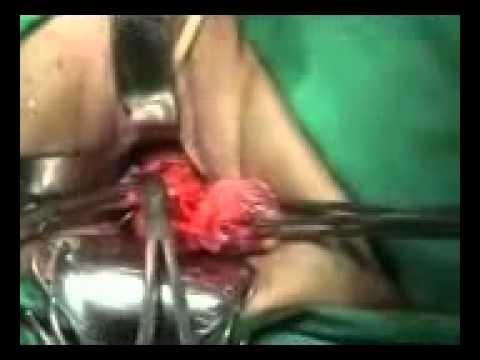 YouTube   Vaginal Surgery   Vaginal Hysterectomy mpeg4