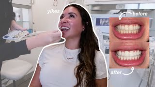 professionally whitening my teeth at the dentist!! (after invisalign)