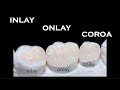 Onlay, Inlay, Coroas e Facetas  O que são?