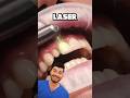 Dental Laser Explained