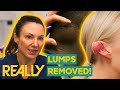 Dr. Emma Removes Painful Lipoma and Keloid From The Neck And Ear! | The Bad Skin Clinic