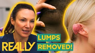 Dr. Emma Removes Painful Lipoma and Keloid From The Neck And Ear! | The Bad Skin Clinic