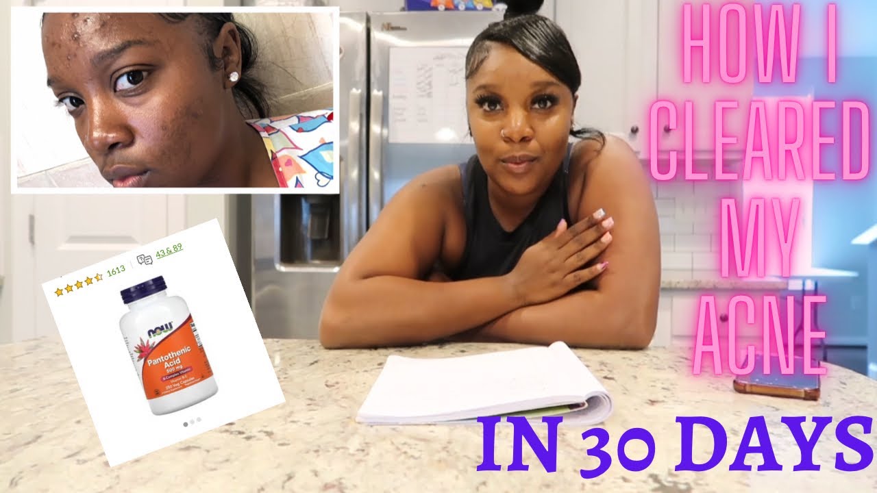 HOW I CLEARED MY ACNE IN 30 DAY| BEFORE & AFTER PICS|PRODUCTS - YouTube