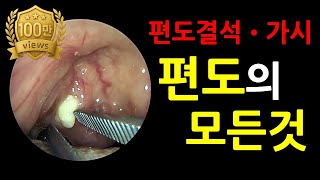이비인후과 편도결석 편도가시 제거 내시경 영상