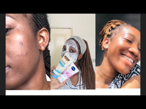 Products I used to clear my acne / skin Care / South African YouTuber ...