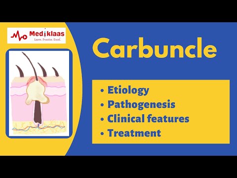 Video: Carbuncle - Causes, Stages And Treatment