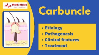 Carbuncle: The cluster of boils | General Surgery | Mediklaas