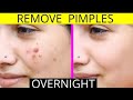 How to remove pimples overnight  acne treatment  healthy gyan