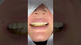 🧑🏻‍🎤💐40대 여성 위전체임플란트 치료과정 40s female full implant process #dental #implnats