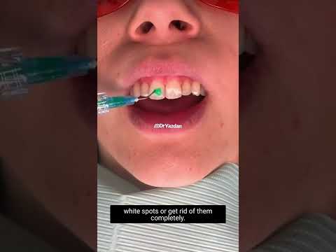 Removing White Spots On Teeth | Cosmetic Dentist Dr. Yazdan