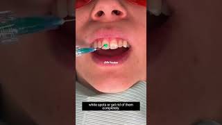Removing White Spots on Teeth | Cosmetic Dentist Dr. Yazdan screenshot 3